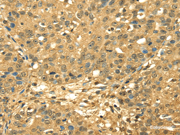 Immunohistochemistry of paraffin-embedded Human breast cancer using RPA2 Polyclonal Antibody at dilution of  1/45