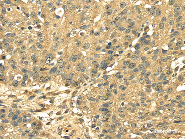 Immunohistochemistry of paraffin-embedded Human breast cancer using RPS3 Polyclonal Antibody at dilution of  1/25