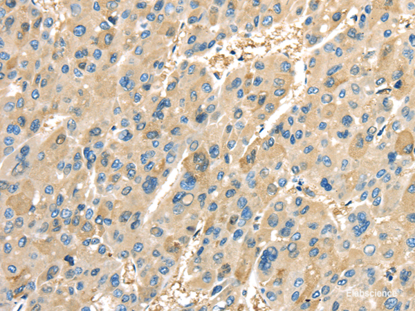 Immunohistochemistry of paraffin-embedded Human liver cancer tissue using COX2 Polyclonal Antibody at dilution 1:40