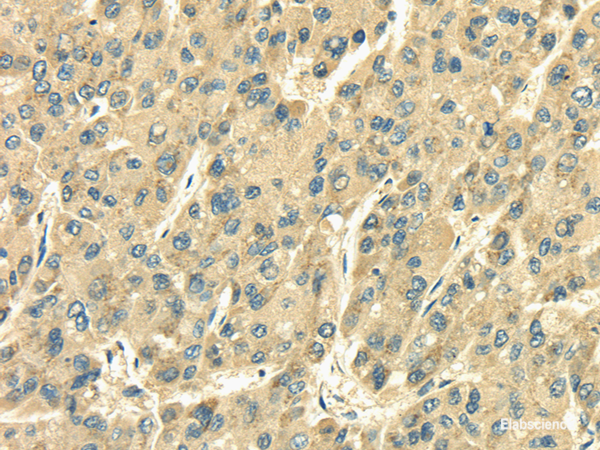 Immunohistochemistry of paraffin-embedded Human liver cancer tissue using SDF4 Polyclonal Antibody at dilution 1:35