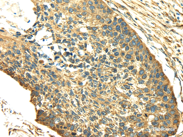 Immunohistochemistry of paraffin-embedded Human esophagus cancer tissue using SDF4 Polyclonal Antibody at dilution 1:40