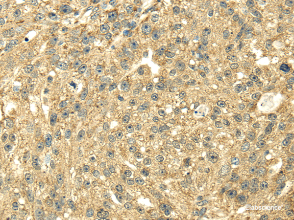 Immunohistochemistry of paraffin-embedded Human breast cancer using SDHA Polyclonal Antibody at dilution of  1/40