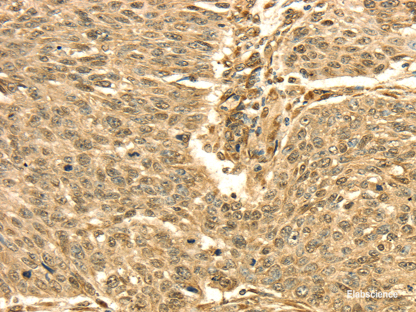 Immunohistochemistry of paraffin-embedded Human lung cancer using SEPT2 Polyclonal Antibody at dilution of  1/30