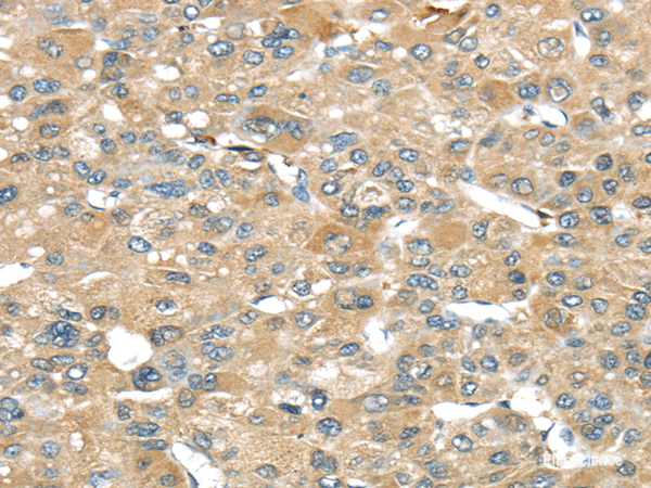 Immunohistochemistry of paraffin-embedded Human liver cancer tissue using SRP54 Polyclonal Antibody at dilution 1:45