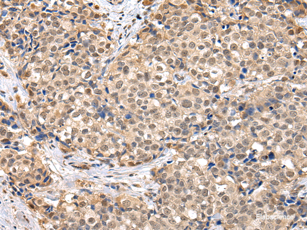 Immunohistochemistry of paraffin-embedded Human breast cancer using TBL1X Polyclonal Antibody at dilution of  1/30
