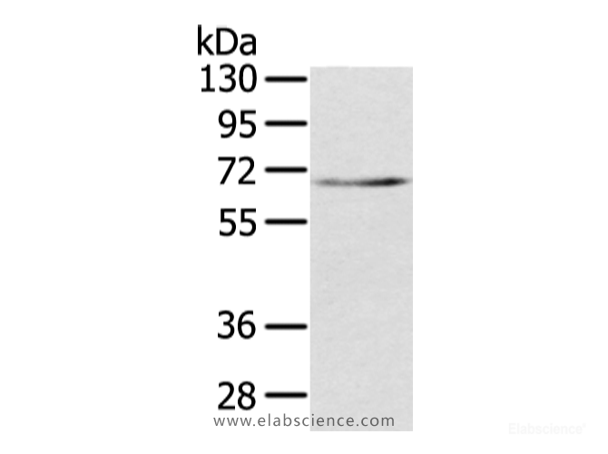 Western Blot analysis of Human lung cancer tissue using TBL1X Polyclonal Antibody at dilution of 1/500