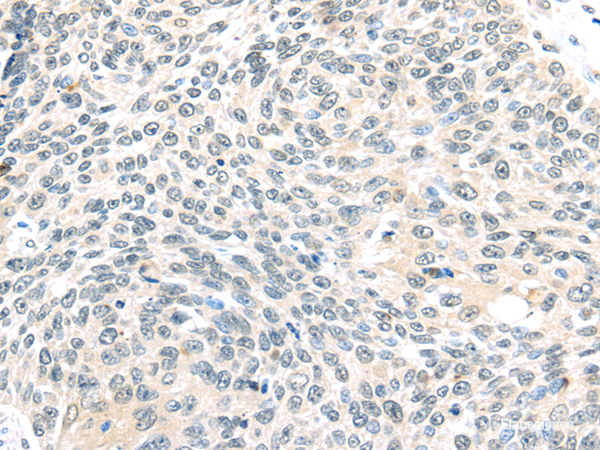 Immunohistochemistry of paraffin-embedded Human lung cancer tissue using ELOC Polyclonal Antibody at dilution 1:40