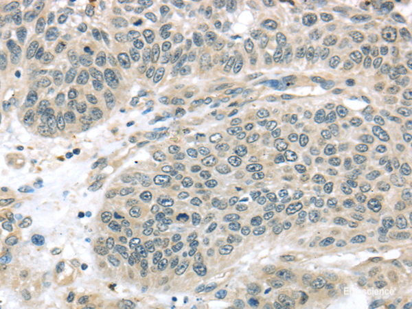 Immunohistochemistry of paraffin-embedded Human lung cancer using THAP4 Polyclonal Antibody at dilution of  1/30