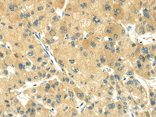 Immunohistochemistry of paraffin-embedded Human liver cancer using TRIM10 Polyclonal Antibody at dilution of  1/35