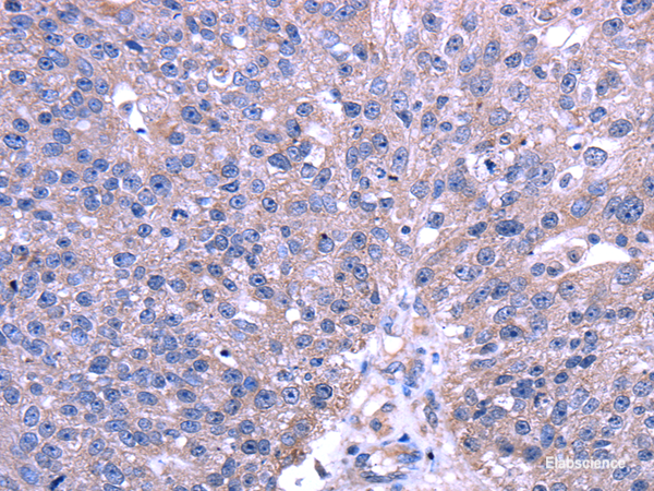 Immunohistochemistry of paraffin-embedded Human breast cancer using TRIM49 Polyclonal Antibody at dilution of  1/40