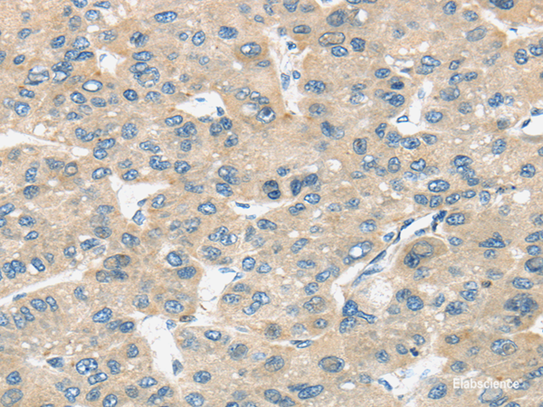 Immunohistochemistry of paraffin-embedded Human liver cancer tissue using TIRAP Polyclonal Antibody at dilution 1:30