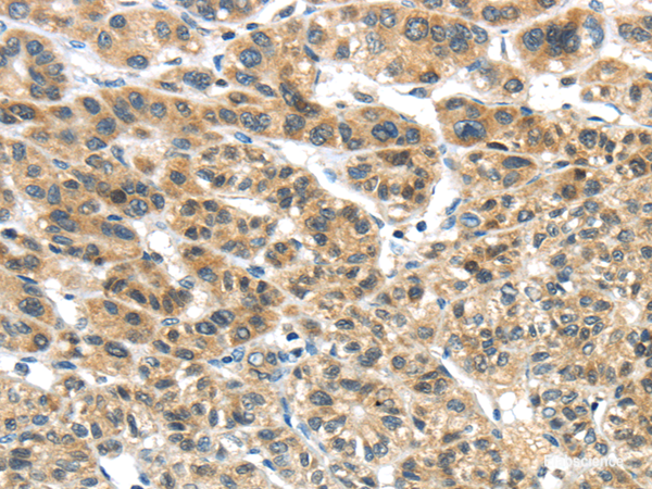 Immunohistochemistry of paraffin-embedded Human liver cancer tissue using TKTL1 Polyclonal Antibody at dilution 1:40