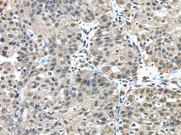 Immunohistochemistry of paraffin-embedded Human breast cancer tissue using FUS Polyclonal Antibody at dilution 1:45