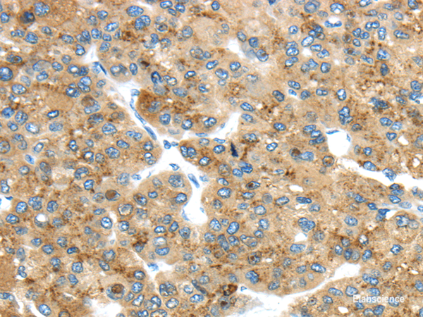Immunohistochemistry of paraffin-embedded Human liver cancer using TMED4 Polyclonal Antibody at dilution of  1/45