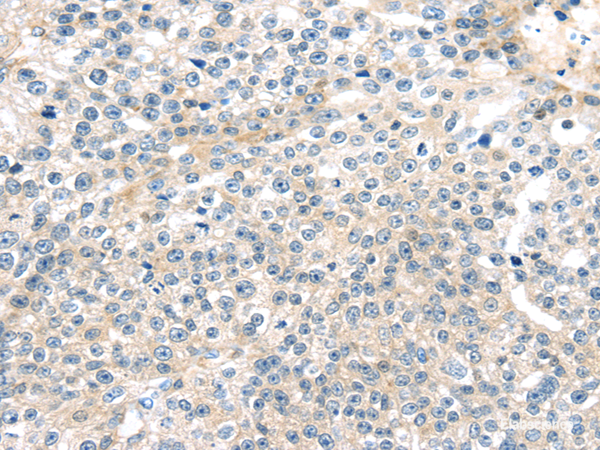 Immunohistochemistry of paraffin-embedded Human breast cancer tissue using TNFAIP8 Polyclonal Antibody at dilution 1:35