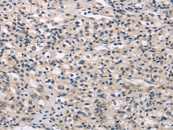 Immunohistochemistry of paraffin-embedded Human prostate cancer using MED28 Polyclonal Antibody at dilution of  1/30