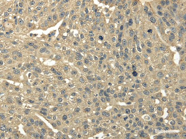 Immunohistochemistry of paraffin-embedded Human breast cancer using TRIB2 Polyclonal Antibody at dilution of  1/30
