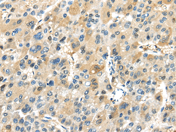 Immunohistochemistry of paraffin-embedded Human liver cancer tissue using TRAIP Polyclonal Antibody at dilution 1:40