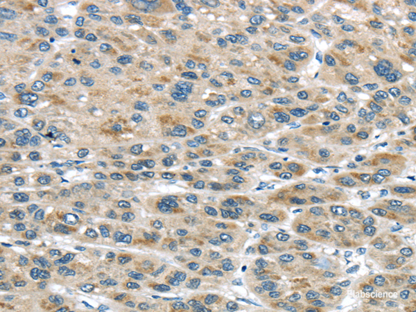 Immunohistochemistry of paraffin-embedded Human liver cancer tissue using TRAIP Polyclonal Antibody at dilution 1:40