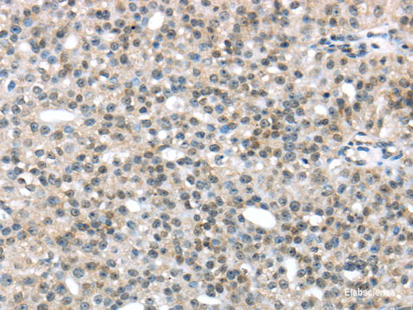 Immunohistochemistry of paraffin-embedded Human breast cancer tissue using TRIP6 Polyclonal Antibody at dilution 1:45