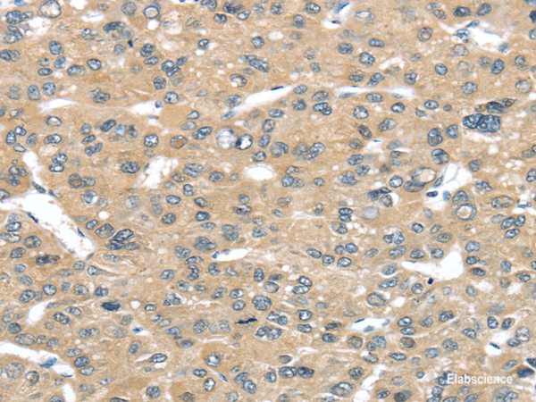 Immunohistochemistry of paraffin-embedded Human liver cancer tissue using TUSC2 Polyclonal Antibody at dilution 1:50
