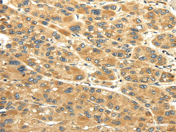 Immunohistochemistry of paraffin-embedded Human liver cancer tissue using UACA Polyclonal Antibody at dilution 1:45