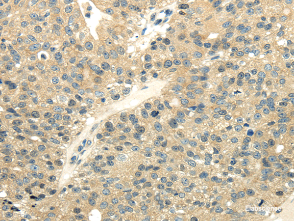 Immunohistochemistry of paraffin-embedded Human breast cancer using UBL4A Polyclonal Antibody at dilution of  1/40