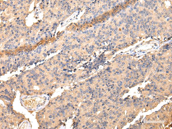Immunohistochemistry of paraffin-embedded Human prostate cancer using SDCBP Polyclonal Antibody at dilution of  1/40