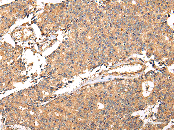 Immunohistochemistry of paraffin-embedded Human prostate cancer using ALDH3A2 Polyclonal Antibody at dilution of  1/20