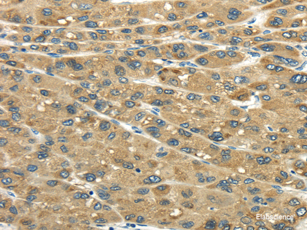 Immunohistochemistry of paraffin-embedded Human liver cancer tissue using UGT2B4 Polyclonal Antibody at dilution 1:45
