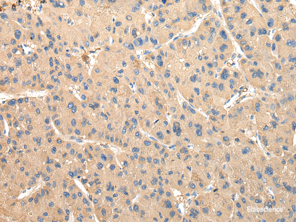 Immunohistochemistry of paraffin-embedded Human liver cancer tissue using DUSP11 Polyclonal Antibody at dilution 1:50