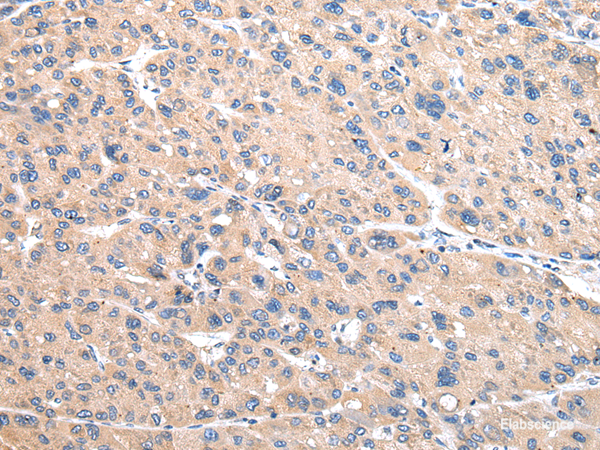 Immunohistochemistry of paraffin-embedded Human liver cancer using VAMP4 Polyclonal Antibody at dilution of  1/30
