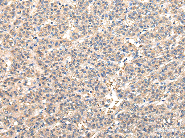 Immunohistochemistry of paraffin-embedded Human liver cancer tissue using VPS45 Polyclonal Antibody at dilution 1:50
