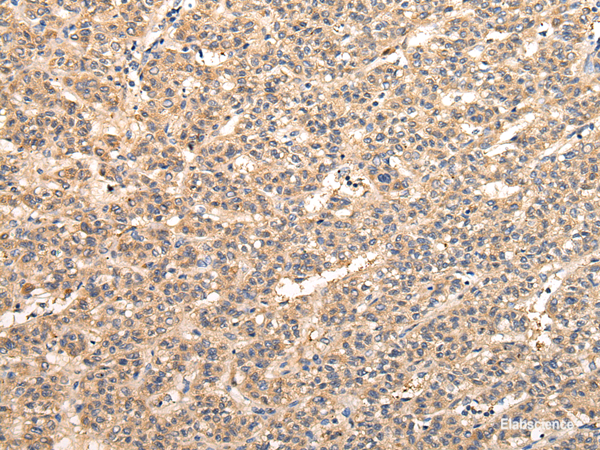 Immunohistochemistry of paraffin-embedded Human liver cancer tissue using VPS33B Polyclonal Antibody at dilution 1:40