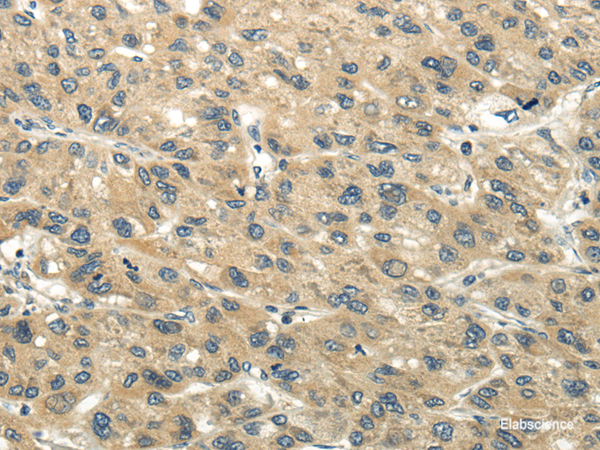 Immunohistochemistry of paraffin-embedded Human liver cancer tissue using CHGB Polyclonal Antibody at dilution 1:40