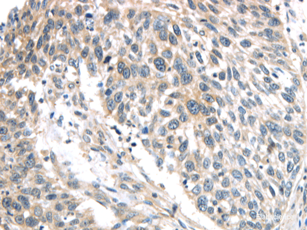 Immunohistochemistry of paraffin-embedded Human lung cancer using IQGAP2 Polyclonal Antibody at dilution of  1/40