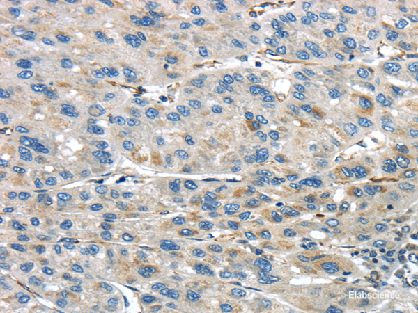 Immunohistochemistry of paraffin-embedded Human liver cancer using IQGAP2 Polyclonal Antibody at dilution of  1/45