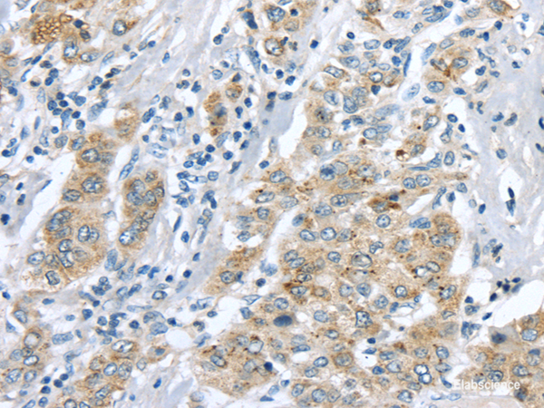 Immunohistochemistry of paraffin-embedded Human liver cancer tissue using LRP6 Polyclonal Antibody at dilution 1:60