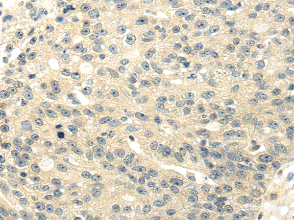 Immunohistochemistry of paraffin-embedded Human breast cancer using GAD1 Polyclonal Antibody at dilution of  1/20