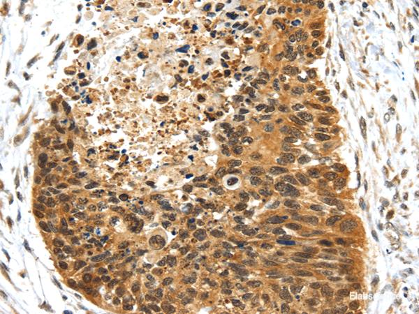 Immunohistochemistry of paraffin-embedded Human esophagus cancer using NR2F2 Polyclonal Antibody at dilution of  1/25