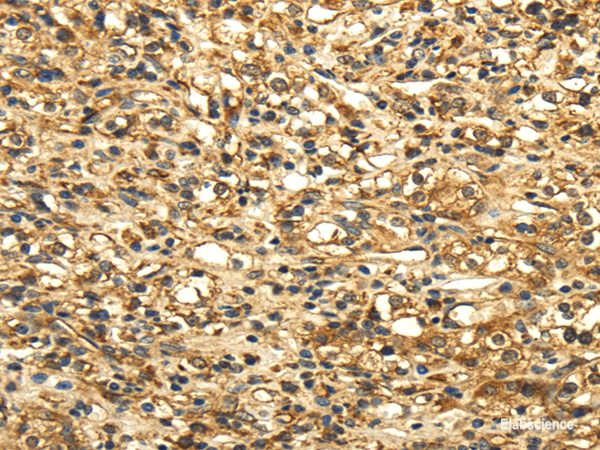 Immunohistochemistry of paraffin-embedded Human prostate cancer tissue using SLC6A19 Polyclonal Antibody at dilution 1:35