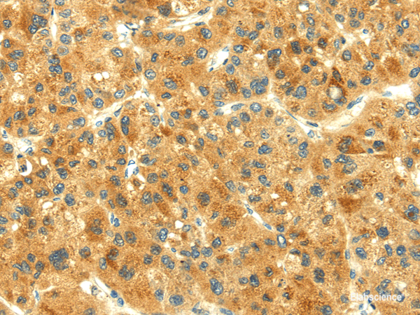 Immunohistochemistry of paraffin-embedded Human liver cancer using THAP3 Polyclonal Antibody at dilution of  1/30