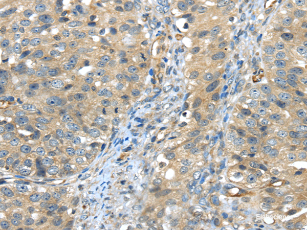 Immunohistochemistry of paraffin-embedded Human breast cancer using ISM2 Polyclonal Antibody at dilution of  1/45