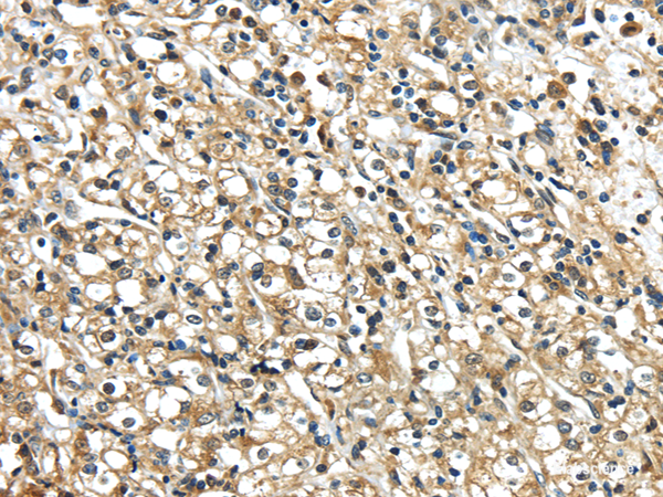 Immunohistochemistry of paraffin-embedded Human prostate cancer using NME2 Polyclonal Antibody at dilution of  1/40