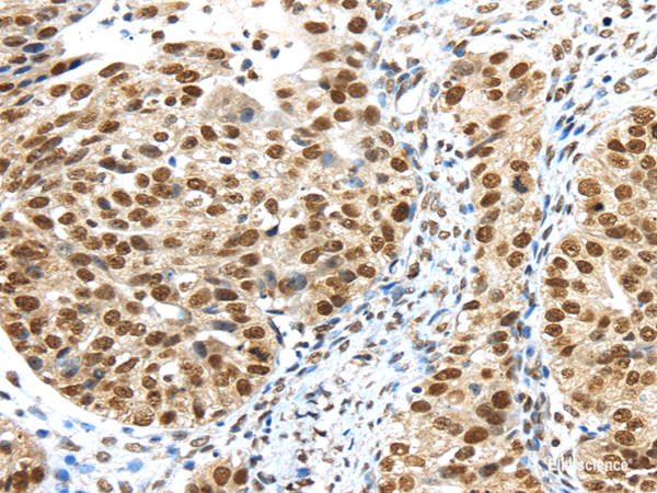 Immunohistochemistry of paraffin-embedded Human breast cancer tissue using TRIM33 Polyclonal Antibody at dilution 1:40