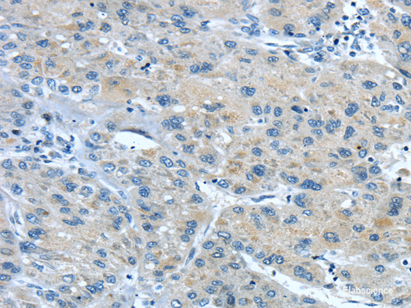 Immunohistochemistry of paraffin-embedded Human liver cancer using TNIP1 Polyclonal Antibody at dilution of  1/35
