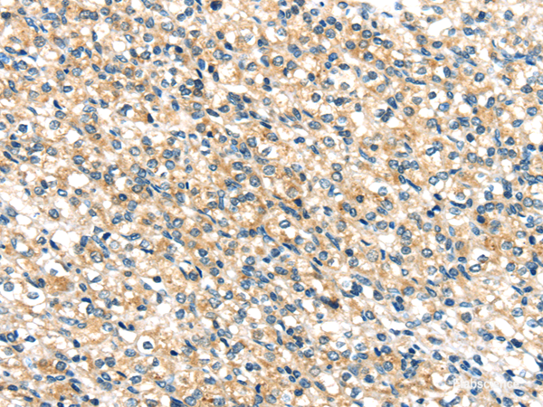 Immunohistochemistry of paraffin-embedded Human prostate cancer tissue using TTI1 Polyclonal Antibody at dilution 1:40
