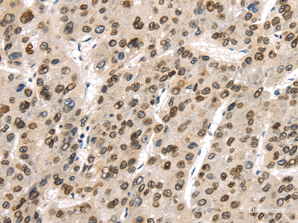 Immunohistochemistry of paraffin-embedded Human liver cancer using TUSC5 Polyclonal Antibody at dilution of  1/40