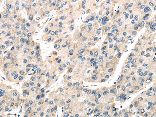 Immunohistochemistry of paraffin-embedded Human liver cancer tissue using TXNIP Polyclonal Antibody at dilution 1:50