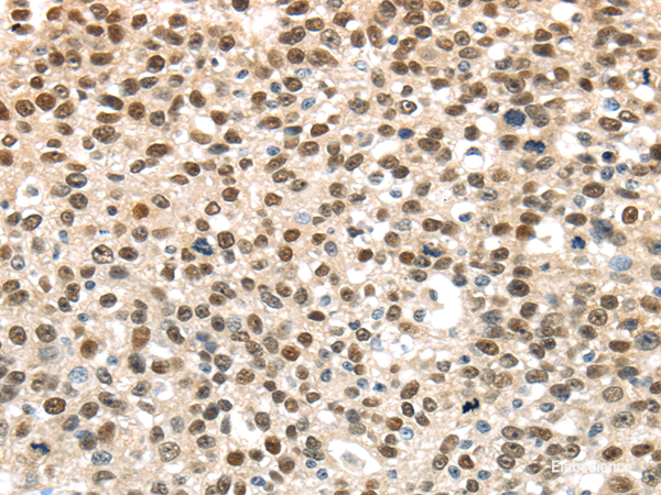 Immunohistochemistry of paraffin-embedded Human breast cancer using UBA1 Polyclonal Antibody at dilution of  1/40